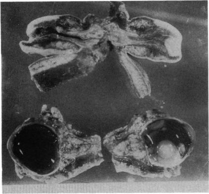 cyclopia