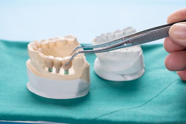 Implant Supported Bridges in Dentistry