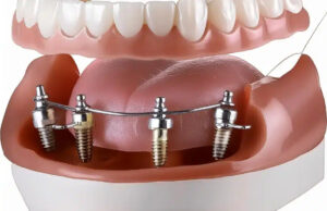 Office Spaces: Essential for the All-on-4 Dental Implant Experience